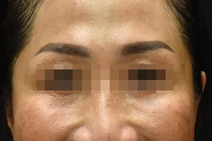 Tiêm độc tố botulinum để làm đẹp da