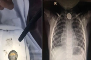 Nuốt viên pin cúc, thực quản bé trai 4 tuổi bỏng nặng