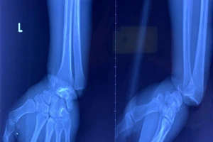 Cọng kẽm cuộn chặt cổ tay do buồn ngủ vì làm suốt ngày