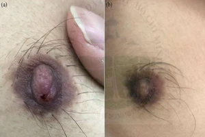 Hy hữu: Nam thanh niên bị giang mai ở đầu vú
