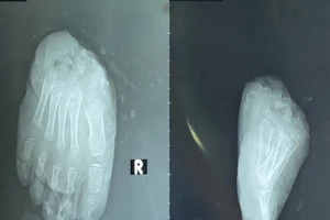 Bàn chân đứt lìa của bé trai 6 tuổi được cứu qua 5 lần phẫu thuật