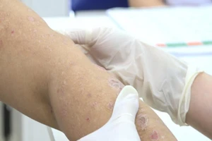 Bệnh vảy nến trở nặng do ám ảnh dịch COVID-19