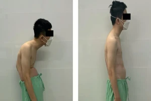 Còng cột sống sau té đập lưng rồi tự mua thuốc uống