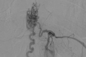 Chớ xem thường 2 chân đột ngột yếu kèm đau lưng