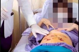 Spa 'khuyến mãi' khách 30 ổ áp xe đầy mủ sau tiêm tan mỡ