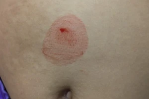 Bé gái 10 tuổi mắc căn bệnh hiếm gặp, 25 năm qua chỉ có 25 ca