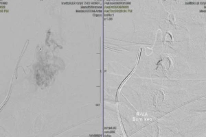 Đi đứng bình thường sau 13 năm yếu liệt 