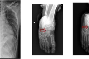 Liệt 2 chân do rơi từ trên cao khi đang sửa thang máy