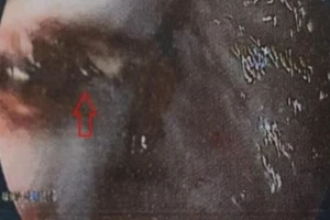 Vỡ thực quản sau cuộc nhậu buổi trưa