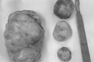 Ngỡ bụng to do mỡ, không ngờ mang 4 khối u 