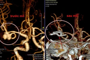Hi hữu: Vỡ mạch máu não khi đang hát karaoke