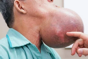 6 tiếng nghẹt thở cứu ca mang khối u khổng lồ trên mặt bị hoại tử