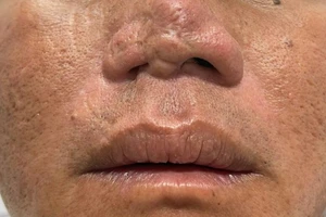 Trả lại cuộc sống cho người mất da vì tai nạn và co rút do bỏng