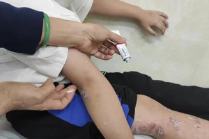 Đừng để trẻ bị chốc khi tới trường