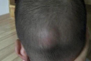 Trẻ té ngã đập đầu xuống đất nhiều lần có ảnh hưởng trí nhớ?