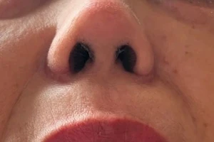 Chủ nhà dùng người giúp việc để thực hành nâng mũi sau ...3 ngày học! 