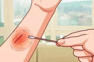 Tại sao phải kiêng ăn gạo nếp khi đang có vết thương hở?