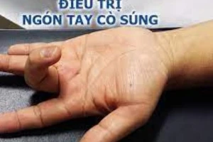 Những điều cần biết về ngón tay cò súng 
