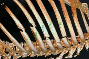 Cứu bệnh nhân lớn tuổi gãy nhiều xương sườn do tai nạn giao thông.