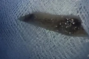 Mẩu xương vịt 2 đầu sắc nhọn đâm xuyên thành thực quản 