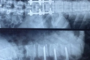 Bệnh nhân gãy cột sống thắt lưng hồi phục nhờ phương pháp cải tiến