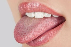 Lưỡi nổi mụn nhỏ, đau rát, phải làm sao bác sĩ ơi?