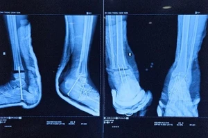 Nối 2 bàn chân gần đứt lìa do máy cắt cỏ