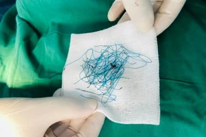 Nhiễm trùng nặng do nâng mũi bằng chỉ