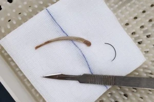 TP.HCM cấp cứu ca hiếm gặp: Mảnh xương gà dài 6 cm kẹt trong phổi