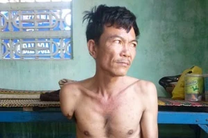 Bị rụng dần chân tay