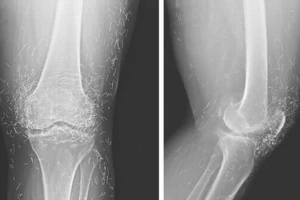 Hàng trăm kim châm cứu bằng vàng trong đầu gối