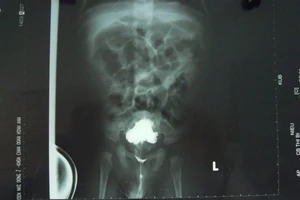 Trẻ bị vỡ bàng quang do dị tật niệu