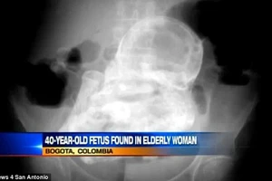 Thai nhi 44 năm trong bụng bà cụ 84 tuổi