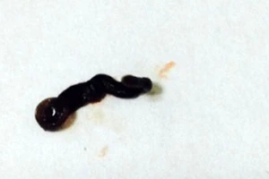 Gắp một con vắt sống trong mắt bệnh nhân