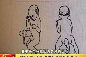 Bé trai 2 tuổi "mang thai" người anh em sinh đôi