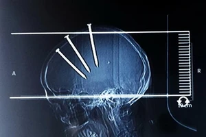 Ba cây đinh cắm vào sọ vẫn sống sót