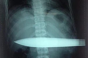 Nhập viện cấp cứu với con dao đâm lút 30 cm vào người
