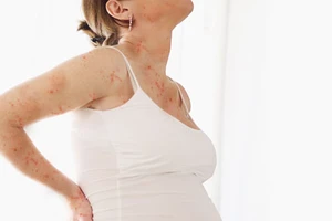 Nhiễm thủy đậu khi mang thai có nguy hiểm?