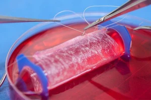 Nuôi, cấy ghép âm đạo cho bệnh nhân không âm đạo