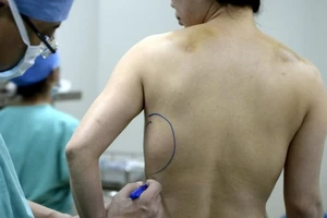 Hoảng hốt vì bộ ngực cấy ghép “chạy” xuống bụng