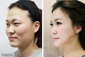 Nhập cảnh không được vì quá đẹp sau giải phẫu thẩm mỹ