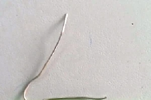 Nội soi lấy cọng kim loại trong phế quản bệnh nhân