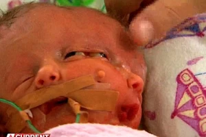 Trẻ sơ sinh có hai khuôn mặt 