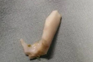 Loét thực quản sau nhiều ngày hóc xương heo