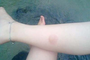 Sơ cứu khi bị bỏng bô xe máy