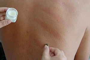 Cạo gió thế nào cho đúng? 