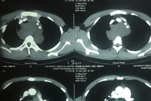 Cảnh giác với hiện tượng vướng khi nuốt, khó thở khi nằm