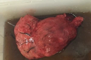 Nữ bệnh nhân bị u tử cung to hơn trái banh nằm trong bụng