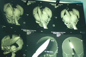 Kẻ lạ mặt đâm dao vào đầu bé trai 11 ngày tuổi ngay tại bệnh viện 