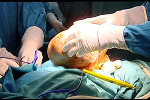 Phẫu thuật khối u nặng hơn 3 kg trên gương mặt nữ bệnh nhân